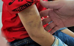 Vụ cháu bé 9 tuổi bị đánh đập dã man: Phát hiện xương bàn tay bị gãy