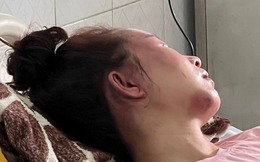 Vụ cán bộ QLTT đánh cô gái dã man: Nạn nhân phải phẫu thuật và theo dõi thêm phần não