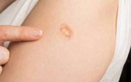 Nếu có vết sẹo huyền thoại này trên cánh tay, bạn đang được bảo vệ khỏi rất nhiều bệnh