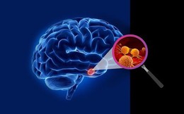 Dấu hiệu đầu tiên khi thức dậy vào buổi sáng báo hiệu khối u não
