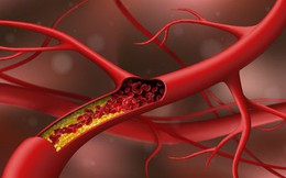 Cholesterol cao: Thêm nguyên nhân bất ngờ, không liên quan ăn uống