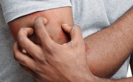 2 dấu hiệu trên da có thể báo hiệu ung thư gan, nếu thấy cần đi khám ngay