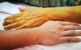 ‘2 vàng’ cảnh báo bệnh gan nhất định không được bỏ qua