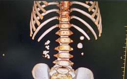 Bé trai 3 tuổi đi khám vì đau thắt lưng, đau mạn sườn, bác sĩ phát hiện bị sỏi thận 2 bên