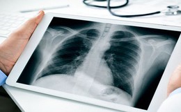 4 'thủ phạm' gây ra ung thư phổi: Số 1 nhiều người Việt vẫn đang duy trì