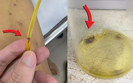 Hy hữu: Sán theo ống dẫn lưu đường mật ra ngoài, 'thủ phạm' đến từ món nhiều người thích