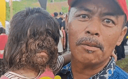 Quốc vương Malaysia chụp ảnh với em bé ‘người sói’