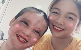 Câu chuyện về cô bé lớp 5 từng bị thiêu sống và nghị lực vươn lên nghịch cảnh sau 4 năm