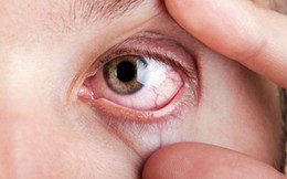 8 tình trạng của mắt cảnh báo bạn đang mắc bệnh hiểm nghèo