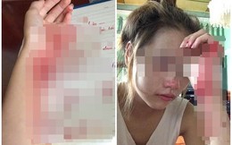 Nhớ người yêu, nữ sinh Hải Phòng tự rạch tay hành hạ bản thân
