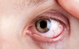 Tia máu trong mắt là bệnh gì?