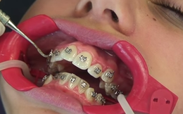 Cận cảnh quy trình nẹp răng khiến ai xem cũng "mỏi mồm"