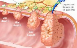 Những dấu hiệu cảnh báo bạn đã mắc ung thư giai đoạn đầu