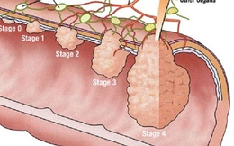 Giật mình vì trực tràng cháu bé 10 tuổi chen chúc 30 polyp