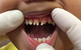 Hãi hùng với hàm răng của trẻ bị nước ngọt phá hủy
