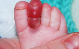 Trẻ có thể mất ngón chân tay chỉ từ... một sợi tóc rụng