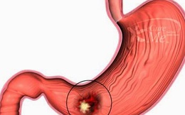Nếu thuộc 5 nhóm người sau, bạn phải cẩn thận với bệnh ung thư dạ dày