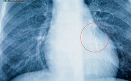 Đi khám răng, bé trai 5 tuổi bị kim nhọn rơi lọt vào phổi
