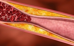 3 dấu hiệu của mỡ máu - căn bệnh giết người âm thầm: Dù gầy hay béo  đều phải cảnh giác