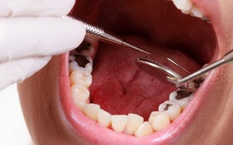 Bị đau răng, nhanh chóng vào bếp lấy 2 loại gia vị để cắt đứt cơn đau