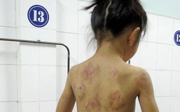 Bé 8 tuổi bị mẹ kế đánh đập lằn roi khắp người