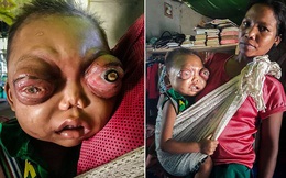 Xót xa bé 2 tuổi mắc bệnh lạ khiến mắt lồi như muốn nổ tung
