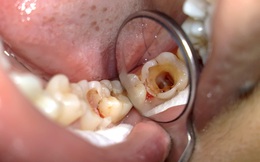 Dù chỉ đau răng thoáng qua, đừng coi thường: Đây có thể là lời cảnh báo bệnh nguy hiểm