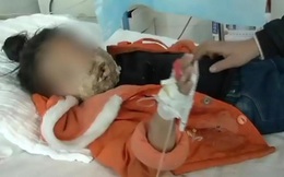 Bé gái 4 tuổi bị biến dạng khuôn mặt vì điện thoại của cha nổ khi đang sạc