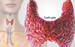 20 triệu người Mỹ mắc bệnh tuyến giáp: Hiểu rõ suy giáp, cường giáp và ung thư tuyến giáp