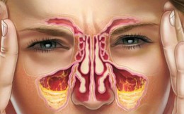 8 cách làm giảm nghẹt mũi tự nhiên mùa này ai cũng nên biết
