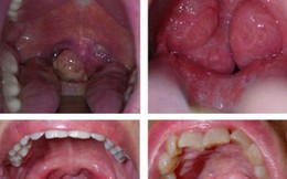 Nhiều người không biết về ung thư amidan: Bác sĩ khuyến cáo 3 dấu hiệu cần vào viện ngay