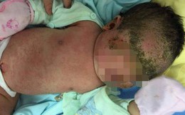 Cha mẹ tự ý tắm lá chữa mụn nhọt khiến con viêm da chảy mủ toàn thân thương tâm