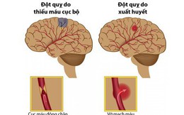 Nhiệt độ miền Bắc giảm sâu: Bác sĩ cảnh báo thời điểm "đen" hay xảy ra đột quỵ