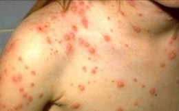 Những thực phẩm nên ăn và nên tránh khi bị thủy đậu