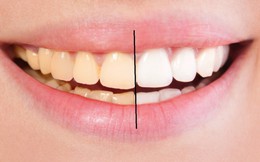8 cách làm trắng răng hiệu quả và an toàn tại nhà: Lưu lại để dùng khi cần đến