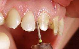 Lạm dụng bọc răng sứ: Điều gì đang đợi bạn ở tương lai?