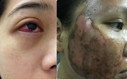 Cô gái bị tụ máu đỏ cả mắt do nhiễm trùng vì thói quen làm đẹp: Chị em hãy cẩn thận!