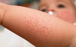 Dấu hiệu nhận biết sốt xuất huyết