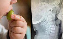 Chỉ vì một quả nho mà bé trai đã bị ngừng thở đến 7 phút sau khi hóc nghẹn
