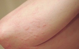 Dị ứng thức ăn có thể gây tử vong?