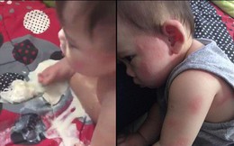 Cậu bé bị nổi ban đỏ, nôn mửa và tiêu chảy nghiêm trọng do uống sữa công thức giả