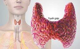 Trưởng khoa Ung bướu BV Tai Mũi Họng TW: Nam giới sờ thấy u ở vị trí này có thể bị ung thư