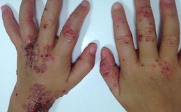 Bé gái bị lây bệnh tình dục vì nụ hôn của cha