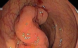 7 anh em ruột ở Hải Dương cùng mắc 1 loại ung thư: Bác sĩ chỉ rõ 6 dấu hiệu bệnh nguy hiểm