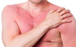 Học ngay một vài biện pháp để phòng ngừa nguy cơ nghiêm trọng xảy ra với cơ thể khi bị dị ứng