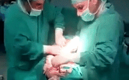 Clip sinh mổ khiến các bác sĩ trong nghề lẫn người xem "nín thở" vì đếm mãi không hết số thai nhi