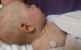Bé 4 tháng tuổi tử vong do bị viêm màng não sau khi tiếp xúc với một người chưa được tiêm chủng tại nhà trẻ