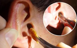 Người đàn ông thủng màng nhĩ vì lấy ráy tai ở tiệm cắt tóc: BS khuyến cáo các nguy cơ
