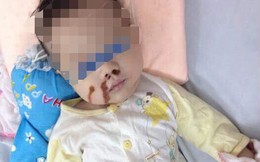 Dì cẩu thả, mẹ vô ý khiến bé 4 tháng tuổi nhập viện cấp cứu