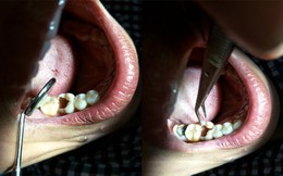Rùng mình chiếc răng rỗng tuếch, vỡ đôi trong miệng bệnh nhân